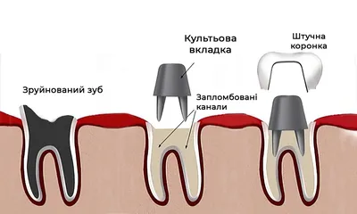 Коронка на зуб | Цены на зубные коронки в Ростове-на-Дону в стоматологии  Чернявского