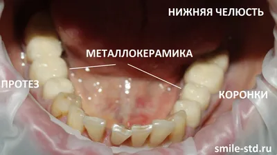 Установка коронки под ключ по спеццене от 2180 грн. | Med Deo