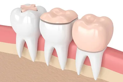 Коронки на зубах занизили прикус и разрушили другие зубы – клиника Smile  STD, Москва