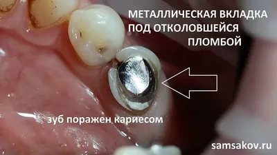 Вкладка на зуб CEREC вместо металлической вкладки, преимущества вкладки  Cerec