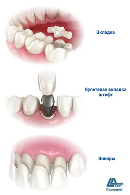 Сравнение зубных пломб с накладками, вкладкам и коронками