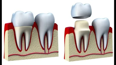 Восстановление полностью разрушенного зуба с помощью культевой вкладки и  коронки из циркония - YouTube