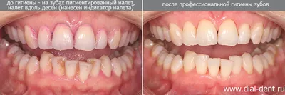 Зубной камень фото до и после фотографии