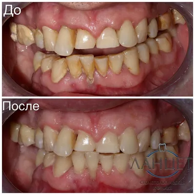 Чистка зубов от камня в стоматологической клинике в Москве \"Ланцет\" -  стоимость лечения