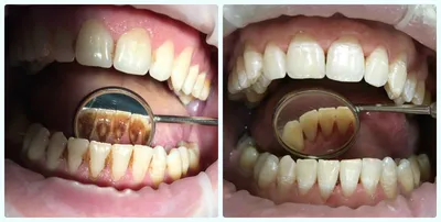 Удаление зубного камня - способы удаление камня | Как вылечить зубной камень