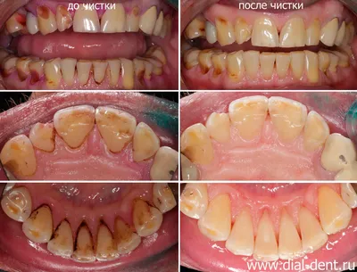 Профессиональная чистка зубов нужна всем