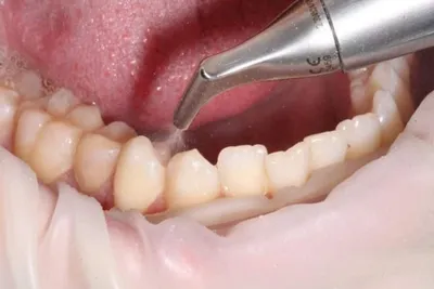 Чистка зубов от камня и налета в Феодосии в стоматологической клинике  «Гармония» недорого