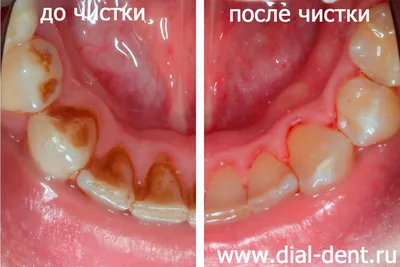 Зубной камень