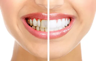 Зубной камень: чем опасен и как от него избавиться — рассказывает  стоматолог | Лёгкая стоматология | Дзен