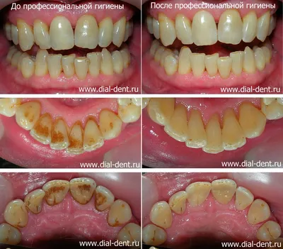 Зубной налет курильщика – профессиональная чистка