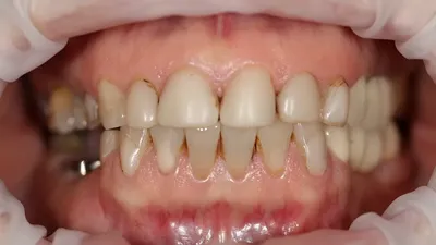 Жалобы на зубной камень, как следствие неприятный запах изо рта, фото до и  после Иркутск