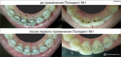 Зубной камень – фото, причины, удаление камней на зубах | Гигиена и  Отбеливание