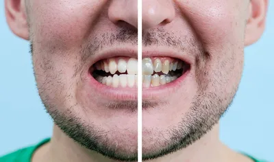 Удаление зубного камня, темного зубного налета ультразвуком и AirFlow.  Гигиена полости рта - YouTube