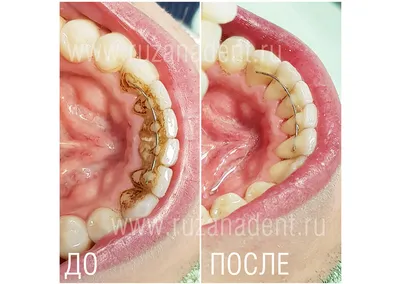 Рейтинг лучших зубных паст для удаления налета и зубного камня