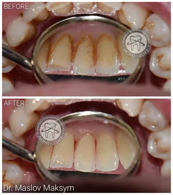 Что такое зубной камень. Как удаляют зубной камень