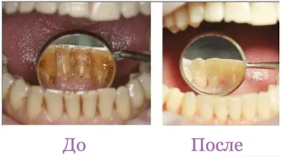 ARAY-Dent - До и после чистки. Зачем нужна профессиональная чистка зубов?  Даже при самой тщательной и старательной чистке зубов, со временем все  равно образуются зубные отложения, зубной камень. Вначале образуется мягкий  налет