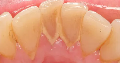 Чистка от зубного камня и налёта в Химках в стоматологической клинике  Специалист