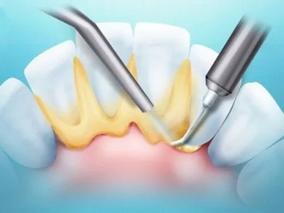 Удаление зубного камня: в чем польза и когда это необходимо? |  Стоматологический центр Статус, Коломна