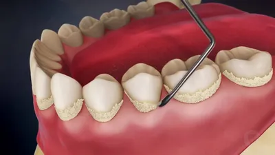 Удаление зубного камня в Москве — цены, рекомендации