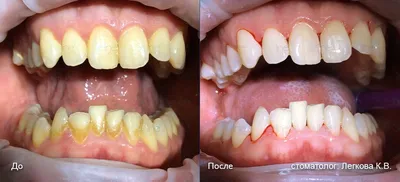 Чистка зубов Air Flow в Москве: цены, фото до и после, отзывы | Стоимость  чистки зубов Air Flow в клинике Seline