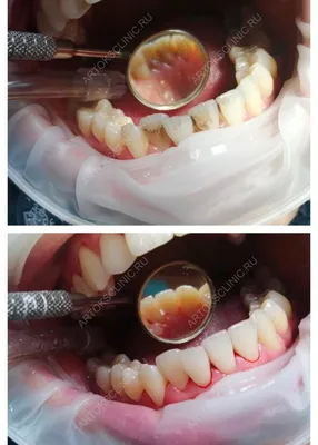 До и после. Профессиональная гигиена полости рта. Налет курильщика. |  Советы стоматолога | Дзен