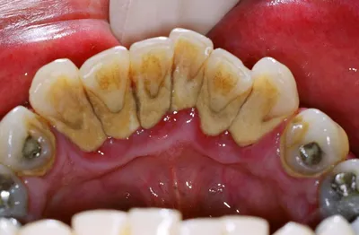 Причины появления зубного камня, способы удаления