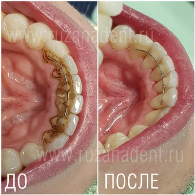 ᐈ Механическая чистка зубного камня Оболонь, цена на механическую чистку  зубов в Киеве | Coral-Dent