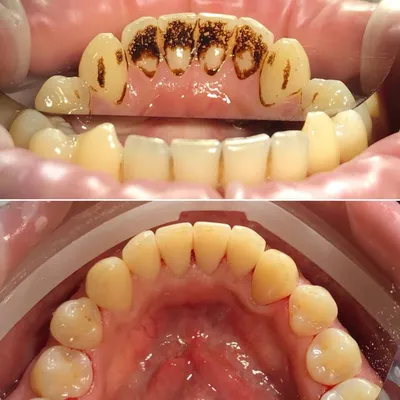 Зубной камень: причины образования и методы удаления – Стоматология МКС