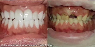 Зубной мост: до и после фотографии