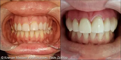 Протезирование зубов Саратов: 18 фото до и после