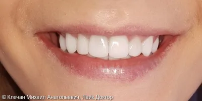 Зубной мост, мостовидный протез Саратов: 8 фото до и после
