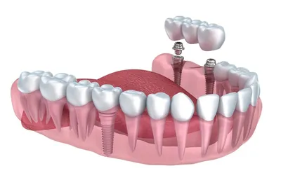 Зубной мост - поставить на 2, 3, 4 зуба – цена в стоматологии Vimontale