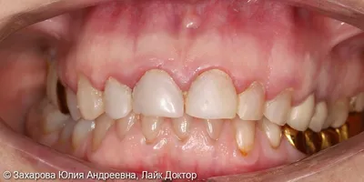 Керамическая коронка cerec: 4 фото до и после