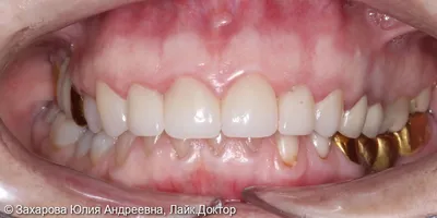 Керамическая коронка cerec: 4 фото до и после