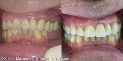 Протезирование зубов Саратов: 18 фото до и после