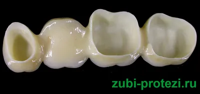 Мостовидные протезы из диоксида циркония –показания к установки, плюсы и  минусы, популярные производители