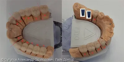 Зубной мост, мостовидный протез Саратов: 8 фото до и после