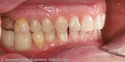 Керамическая коронка cerec: 4 фото до и после