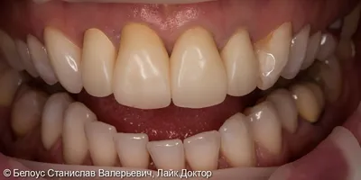 Керамическая коронка cerec: 4 фото до и после