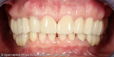 Зубной мост, мостовидный протез: 70 фото до и после