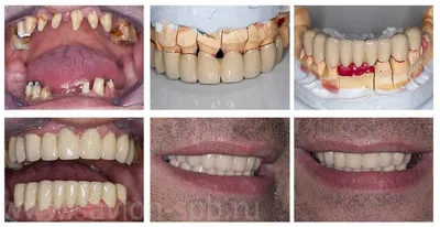 Зубной мост фото до и после фотографии
