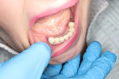 Протезирование с реконструкцией прикуса и восстановлением утраченных зубов  имплантами