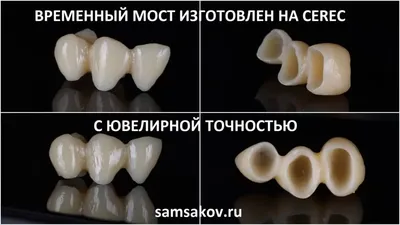 Зубной мост на 3 зуба в Москве, цена под ключ от Дантистофф