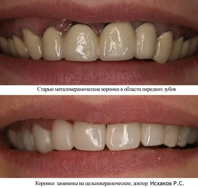 Мостовидные протезы зубов - поставить зубной мост недорого в Москве |  НоваДент