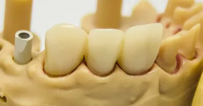 Ремонт зубных протезов и коронок в Уфе | Стоматологическая клиника «Маэстро»