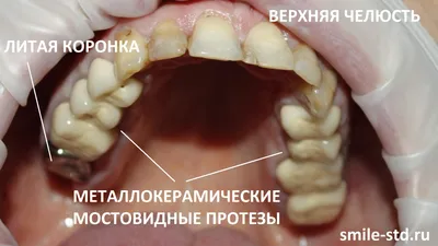 Протезирование зубов – особенности, технологии, цены | Клиника Май