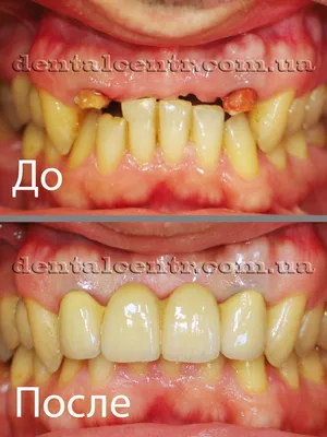 Бюгельный протез зубов — что это такое, виды, фото и уход за бюгельными  зубными протезами