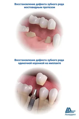 Зубной мост на 3 зуба за 1 визит к врачу – ортопед Сергей Самсаков, Москва