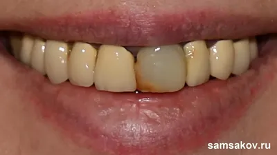 Мостовидное протезирование зубов в Запорожье | Dental Studio