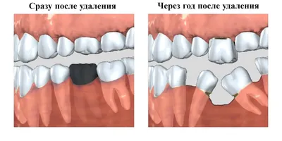 Протезирование зубов без обточки соседних зубов: отзывы и цены